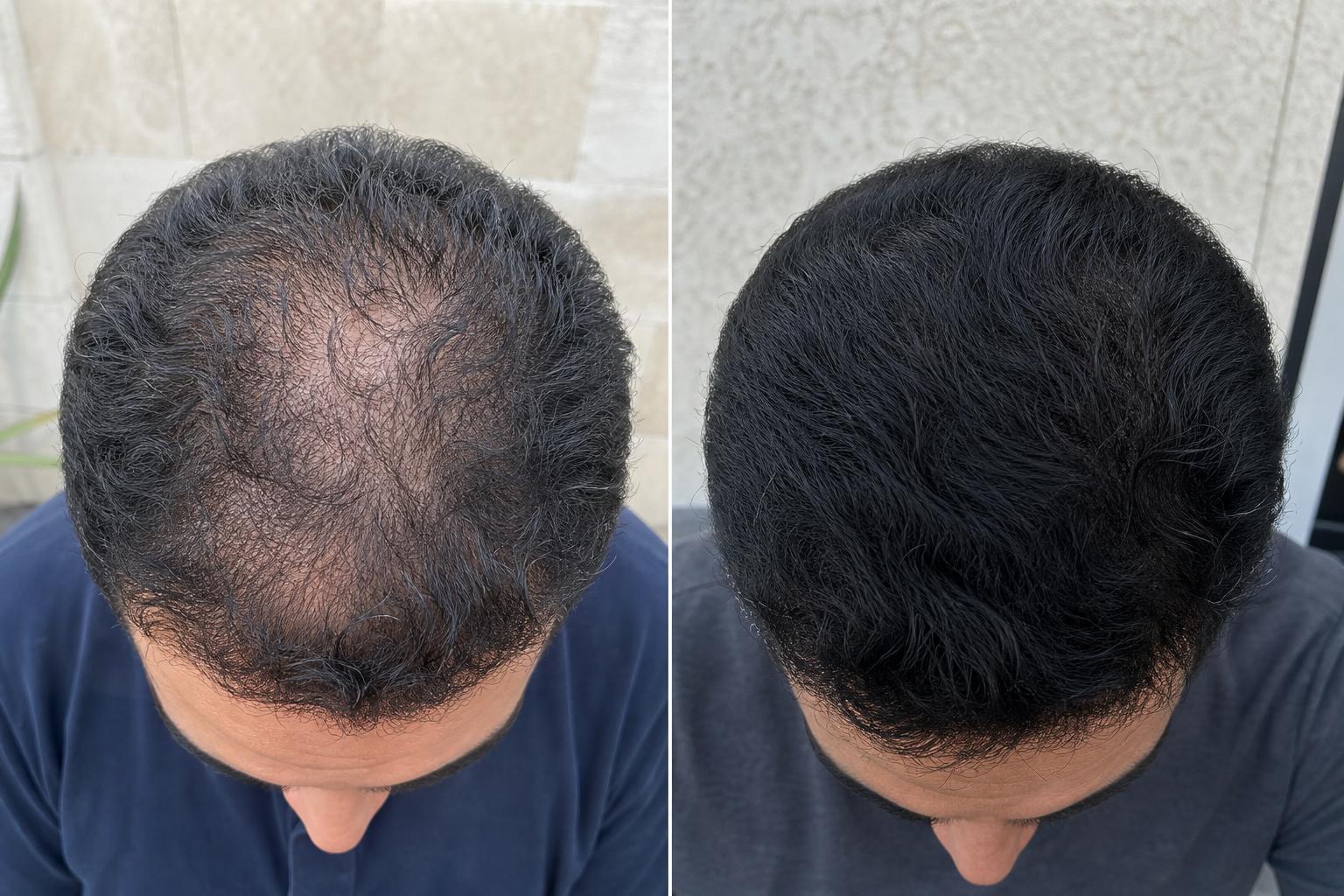 Rami, Dubai, hair regrowth at 4 Months