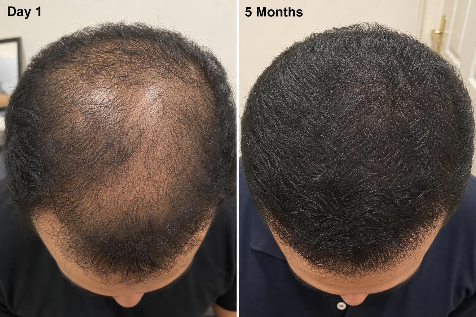 Tariq, Abu Dhabi, hair regrowth at 5 Months